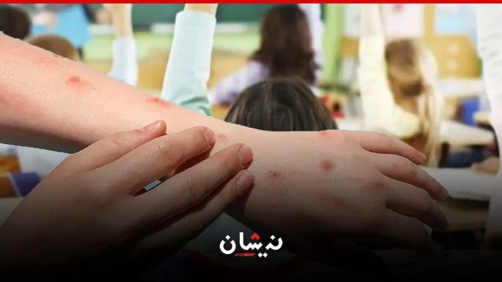تسجيل حالات إصابة بالجُدري وسط التلاميذ بمراكش يرعب الأسر