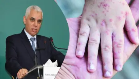 جدري القدرة يؤجل مؤتمر الصحة العامة بإفريقيا في المغرب