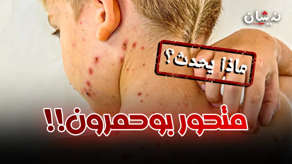 متحور بوحمرون يجتاح المغرب..وخبراء يحذرون