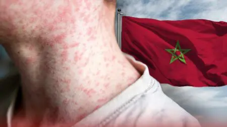 تفشي مقلق لـ “بوحمرون” بالمغرب.. والجمعيات الطبية تحذر من كارثة صحية