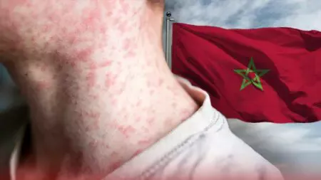 تفشي مقلق لـ “بوحمرون” بالمغرب.. والجمعيات الطبية تحذر من كارثة صحية