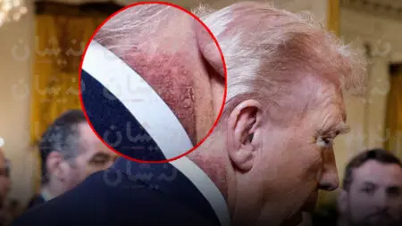 لغز “البقعة الحمراء” يضع صحة الرئيس الأمريكي في دائرة الجدل